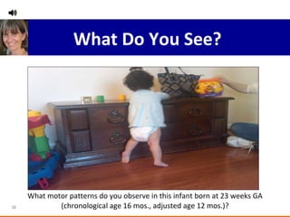What motor patterns do you observe in this infant born at 23 weeks GA (chronological age 16 mos., adjusted age 12 mos.)? What Do You See? 