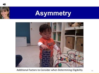 Asymmetry Additional Factors to Consider when Determining Eligibility  