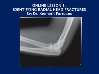 ONLINE LESSON 1:  IDENTIFYING RADIAL HEAD FRACTURES By: Dr. Kenneth Fortgang 
