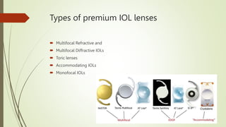 Types of premium IOL lenses
 Multifocal Refractive and
 Multifocal Diffractive IOLs
 Toric lenses
 Accommodating IOLs
...