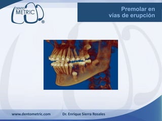 www.dentometric.com Dr. Enrique Sierra Rosales
Premolar en
vías de erupción
 