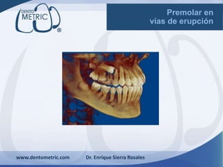 www.dentometric.com Dr. Enrique Sierra Rosales
Premolar
Retenida
 