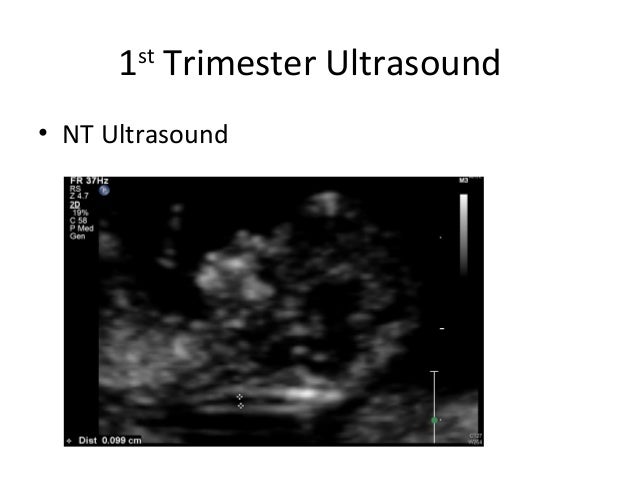 1st Trimester Ultrasound â¢ NT Ultrasound  