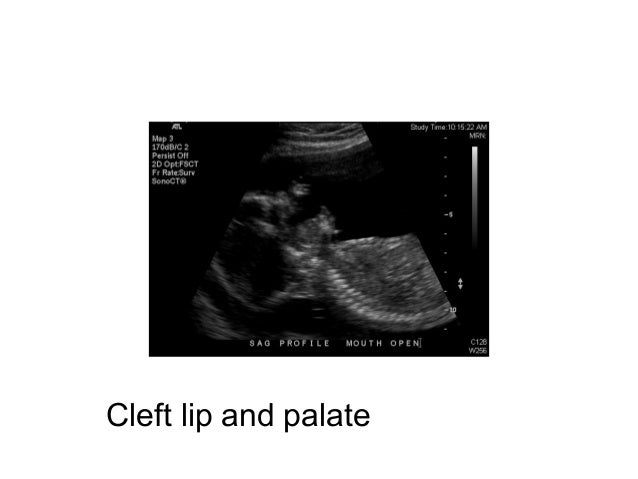 Cleft lip and palate  