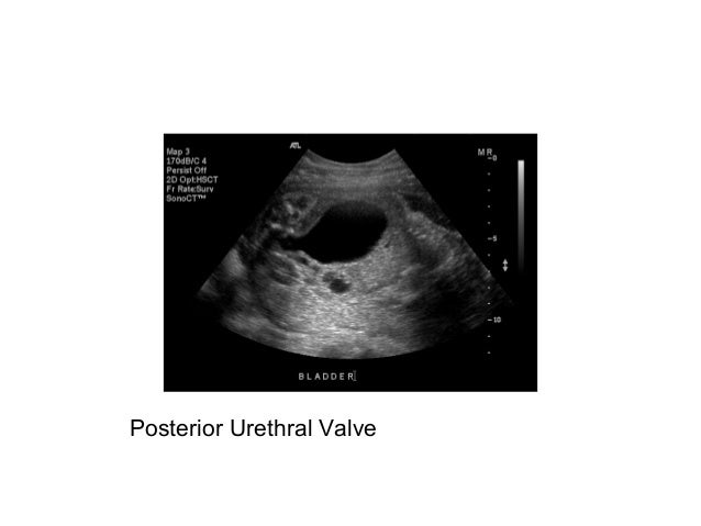Posterior Urethral Valve  