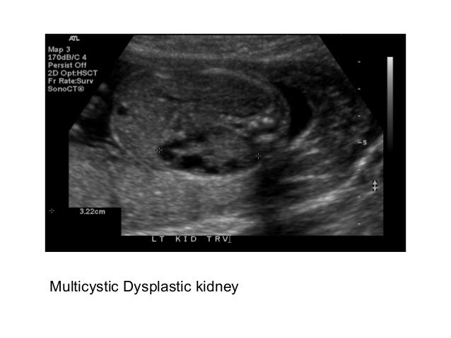 Multicystic Dysplastic kidney  