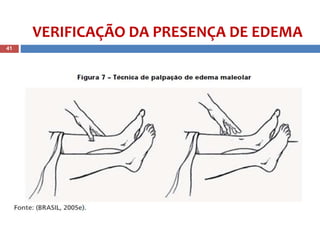VERIFICAÇÃO DA PRESENÇA DE EDEMA
41
 
