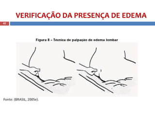 42
VERIFICAÇÃO DA PRESENÇA DE EDEMA
 