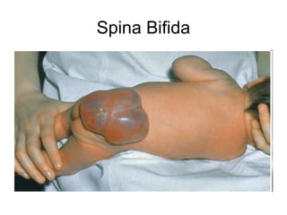 Spina Bifida
 