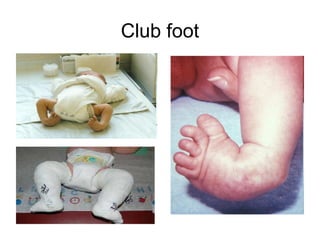 Club foot
 