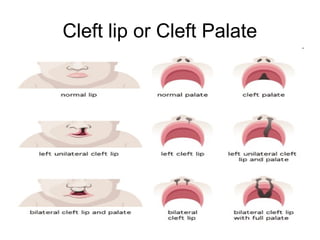 Cleft lip or Cleft Palate
 