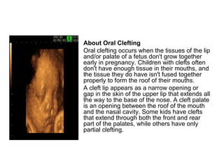 • About Oral Clefting
• Oral clefting occurs when the tissues of the lip
and/or palate of a fetus don't grow together
early in pregnancy. Children with clefts often
don't have enough tissue in their mouths, and
the tissue they do have isn't fused together
properly to form the roof of their mouths.
• A cleft lip appears as a narrow opening or
gap in the skin of the upper lip that extends all
the way to the base of the nose. A cleft palate
is an opening between the roof of the mouth
and the nasal cavity. Some kids have clefts
that extend through both the front and rear
part of the palates, while others have only
partial clefting.
 