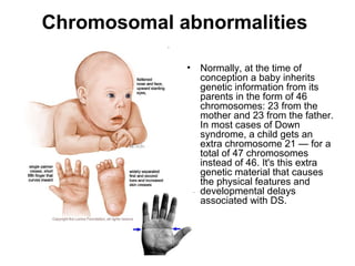 Chromosomal abnormalities
• Normally, at the time of
conception a baby inherits
genetic information from its
parents in the form of 46
chromosomes: 23 from the
mother and 23 from the father.
In most cases of Down
syndrome, a child gets an
extra chromosome 21 — for a
total of 47 chromosomes
instead of 46. It's this extra
genetic material that causes
the physical features and
developmental delays
associated with DS.
 