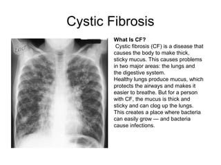 Cystic Fibrosis
What Is CF?
Cystic fibrosis (CF) is a disease that
causes the body to make thick,
sticky mucus. This causes problems
in two major areas: the lungs and
the digestive system.
Healthy lungs produce mucus, which
protects the airways and makes it
easier to breathe. But for a person
with CF, the mucus is thick and
sticky and can clog up the lungs.
This creates a place where bacteria
can easily grow — and bacteria
cause infections.
 