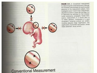 Prenatal diagnosis and fetal therapy | PPTX