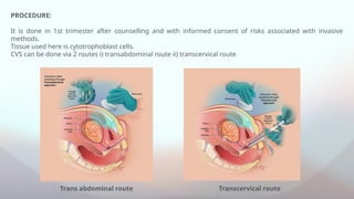 Trans abdominal route Transcervical route
PROCEDURE:
It is done in 1st trimester after counselling and with informed consent of risks associated with invasive
methods.
Tissue used here is cytotrophoblast cells.
CVS can be done via 2 routes i) transabdominal route ii) transcervical route
 