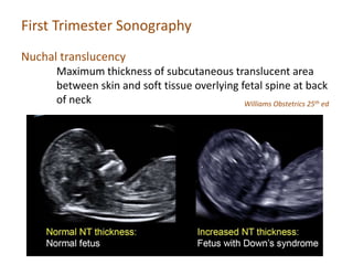 First Trimester Sonography
Nuchal translucency
Maximum thickness of subcutaneous translucent area
between skin and soft tissue overlying fetal spine at back
of neck Williams Obstetrics 25th ed
 