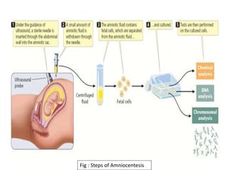 Fig : Steps of Amniocentesis
 