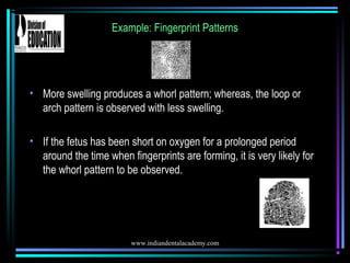www.indiandentalacademy.com
Example: Fingerprint Patterns
• More swelling produces a whorl pattern; whereas, the loop or
a...