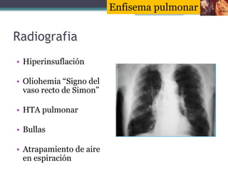 Radiografia
• Hiperinsuflación
• Oliohemia “Signo del
vaso recto de Simon”
• HTA pulmonar
• Bullas
• Atrapamiento de aire
...