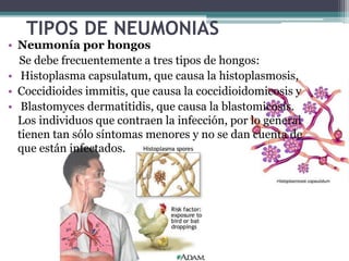 TIPOS DE NEUMONIAS
• Neumonía por Pneumocystis
carinii
• El Pneumocystis carinii es un
microorganismo común que puede
resi...