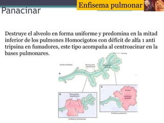 Panacinar
Destruye el alveolo en forma uniforme y predomina en la mitad
inferior de los pulmones Homocigotos con déficit d...