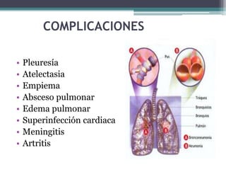 enfermedades pulmonares, enfisema pulmonar, NEUMONIA,