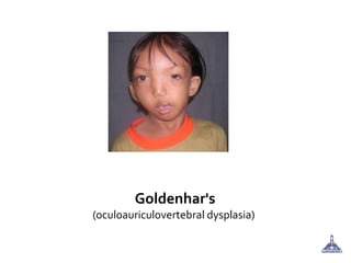 Goldenhar's
(oculoauriculovertebral dysplasia)
 