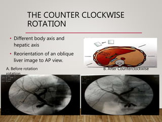 THE COUNTER CLOCKWISE
ROTATION
• Different body axis and
hepatic axis
• Reorientation of an oblique
liver image to AP view.
A. Before rotation B. After Counterclockwise
rotation
 