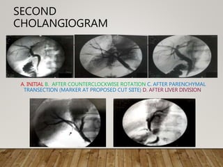 SECOND
CHOLANGIOGRAM
A. INITIAL B. AFTER COUNTERCLOCKWISE ROTATION C. AFTER PARENCHYMAL
TRANSECTION (MARKER AT PROPOSED CUT SIITE) D. AFTER LIVER DIVISION
 
