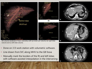 • Done on 3 D work station with volumetric software.
• Line drawn from IVC along MHV to the GB fossa
• Manually mark the borders of the Rt and left lobes
with software assisted interpolation in the intervening
images
3D-volume rendered CT liver volumetry with (a) total liver volume, (b) right lobe
volume and (c) left lobe volume.
 