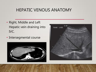 HEPATIC VENOUS ANATOMY
• Right, Middle and Left
Hepatic vein draining into
IVC.
• Intersegmental course
 