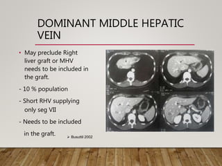 DOMINANT MIDDLE HEPATIC
VEIN
• May preclude Right
liver graft or MHV
needs to be included in
the graft.
- 10 % population
- Short RHV supplying
only seg VII
- Needs to be included
in the graft.  Busuttil 2002
 