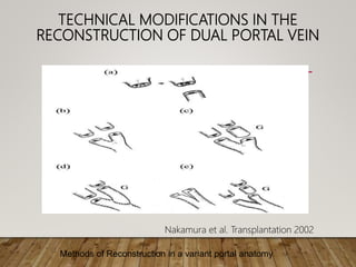TECHNICAL MODIFICATIONS IN THE
RECONSTRUCTION OF DUAL PORTAL VEIN
Methods of Reconstruction in a variant portal anatomy
Nakamura et al. Transplantation 2002
 