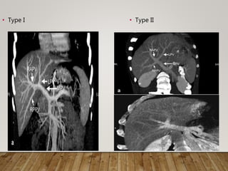 • Type I • Type II
 