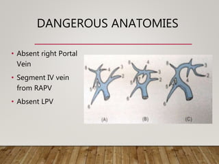 DANGEROUS ANATOMIES
• Absent right Portal
Vein
• Segment IV vein
from RAPV
• Absent LPV
 