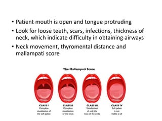 • Patient mouth is open and tongue protruding
• Look for loose teeth, scars, infections, thickness of
neck, which indicate difficulty in obtaining airways
• Neck movement, thyromental distance and
mallampati score
 