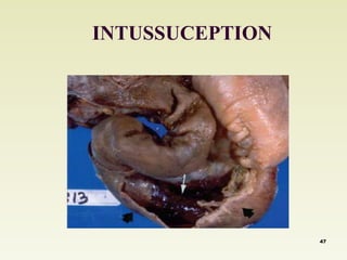 INTUSSUCEPTION 
47 
 