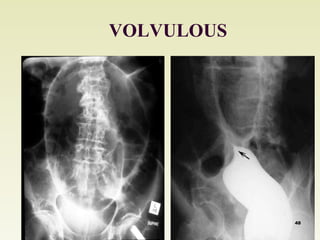 VOLVULOUS 
48 
 