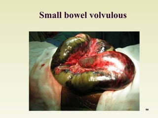Small bowel volvulous 
50 
 