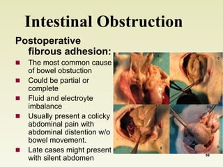 Intestinal Obstruction 
Postoperative 
fibrous adhesion: 
 The most common cause 
of bowel obstuction 
 Could be partial or 
complete 
 Fluid and electroyte 
imbalance 
 Usually present a colicky 
abdominal pain with 
abdominal distention w/o 
bowel movement. 
 Late cases might present 
with silent abdomen 
52 
 