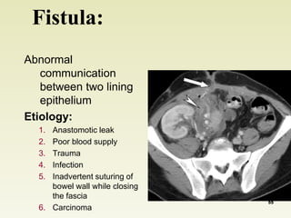 Fistula: 
Abnormal 
communication 
between two lining 
epithelium 
Etiology: 
1. Anastomotic leak 
2. Poor blood supply 
3. Trauma 
4. Infection 
5. Inadvertent suturing of 
bowel wall while closing 
the fascia 
6. Carcinoma 
55 
 