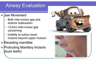 Airway EvaluationJaw MovementBoth inter-incisor gap and anterior subluxation<3.5cm inter-incisor gap concerningInability to sublux lower incisors beyond upper incisorsReceding mandibleProtruding Maxillary Incisors (buck teeth)