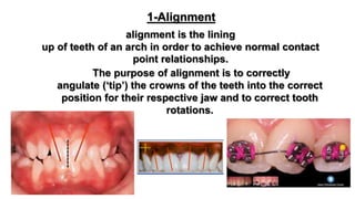 Teeth Alignment Rotations Preoperative orthodontics for orthognathic surgery | PPTX