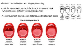 -Patients mouth is open and tongue protruding
-Look for loose teeth, scars, infections, thickness of neck
which indicates difficulty in visualizing airway
-Neck movement, thyromental distance, and Mallampati score
 