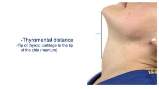 -Thyromental distance
-Tip of thyroid cartilage to the tip
of the chin (mentum)
 