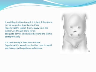 Two Fingerbreadths Preoperative preparation for surgery | PPTX