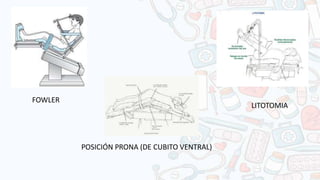 FOWLER
LITOTOMIA
POSICIÓN PRONA (DE CUBITO VENTRAL)
 