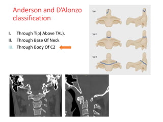 preop planning for odontoid fracture.pptx