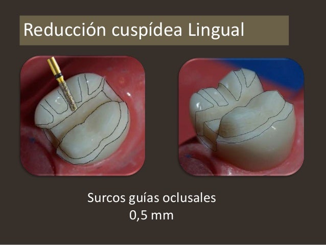 Preparación biológica para onlay 3.7